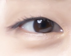 비절개 눈매교정 STEP 01
