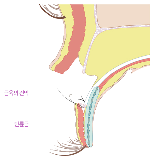 절개 눈매교정 해부도 — 건막 전진과 안륜근 보존