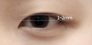안검하수 눈 — 측정 일러스트