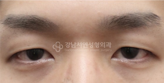 남자 눈성형 수술 전
