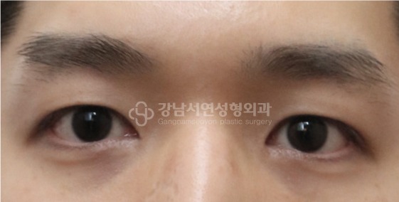 남자 눈성형 수술 후