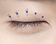 남자 비절개 눈매교정 STEP 04