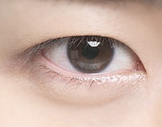 남자 비절개 눈매교정 STEP 05