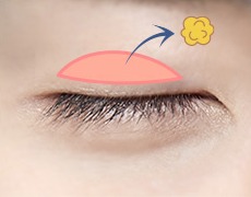 남자 절개 눈매교정 STEP 03