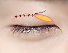 남자 절개 눈매교정 STEP 04