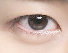 남자 절개 눈매교정 STEP 05