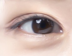 눈썹거상술 STEP 04