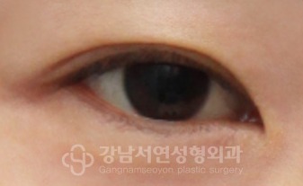 뒤트임·밑트임 수술 전