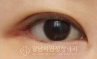 뒤트임·밑트임 수술 후