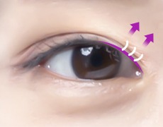 앞트임 STEP 03