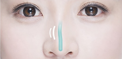 보형물이 이동하는 경우