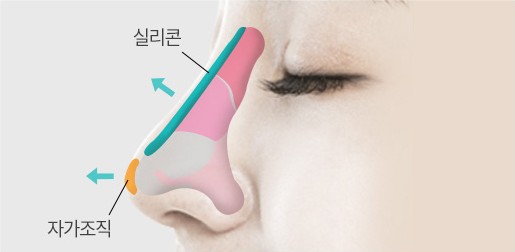 매부리코 성형(증상 심함) STEP 03 — 콧대 보강