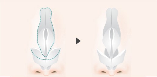 복코 성형 — 날개연골이 큰 경우