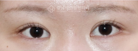 좌우 라인 대칭 교정 후