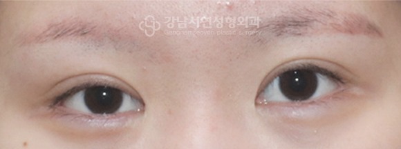 좌우 라인이 다른 짝눈 — 수술 전