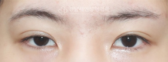 한쪽 안검하수 — 수술 전