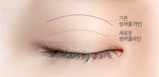 두줄따기 — 기존 쌍꺼풀 라인 아래에 새 라인을 잡는 모식도
