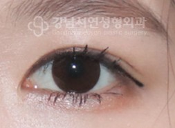 한줄따기 AFTER
