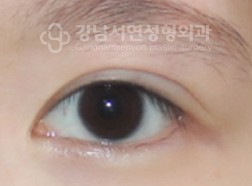 한줄따기 BEFORE