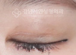 한줄따기 AFTER (감은 눈)