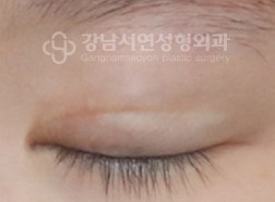 한줄따기 BEFORE (감은 눈)