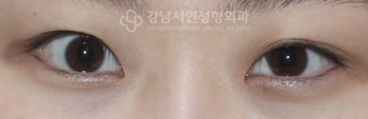 퇴축 눈 — 수술로 과하게 들려 과하게 떠진 눈