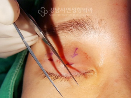 수술 중 매몰실을 제거하는 장면 — 촬영 보관