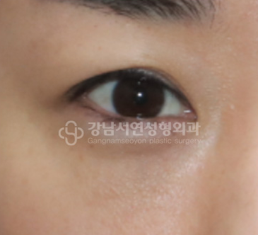 단순 지방 돌출형 — 수술 후