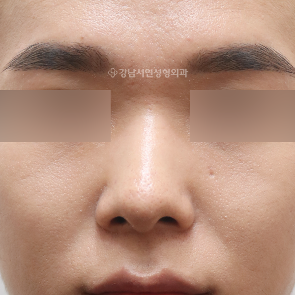 무보형물 코성형 AFTER