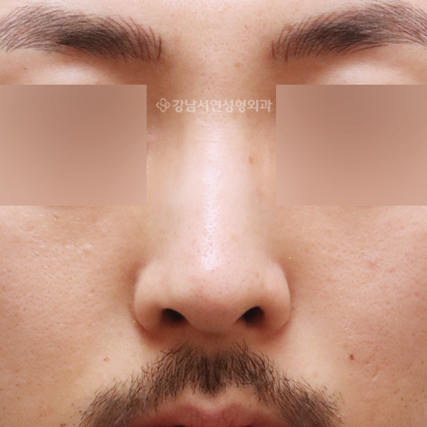 코성형 AFTER