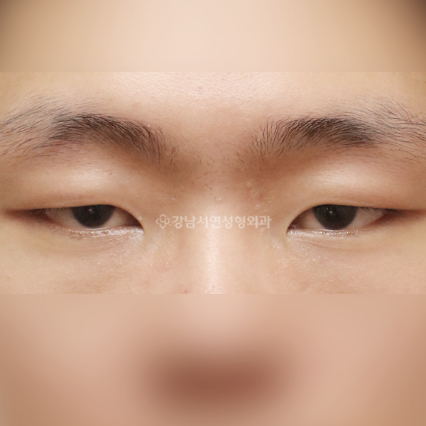 절개눈매교정 BEFORE