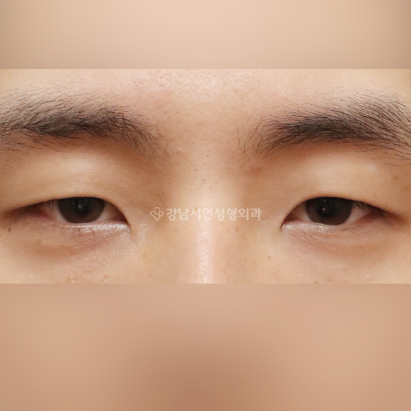 절개눈매교정+앞트임 BEFORE