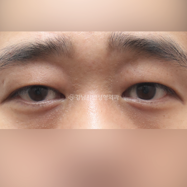 절개눈매교정 AFTER