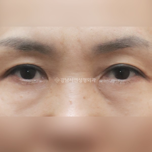 상안검 + 하안검 + 앞트임 AFTER
