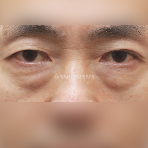 하안검 BEFORE