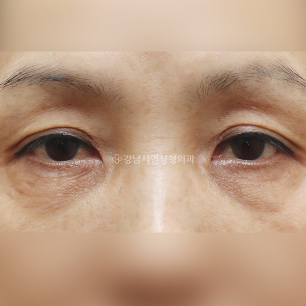 상안검 + 하안검 BEFORE