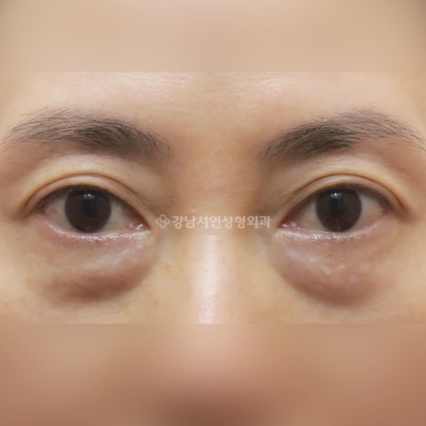 하안검 BEFORE