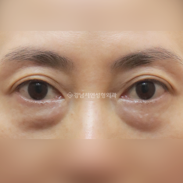 하안검 BEFORE