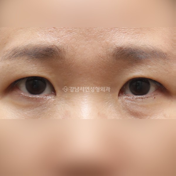 절개눈매교정+앞트임 AFTER