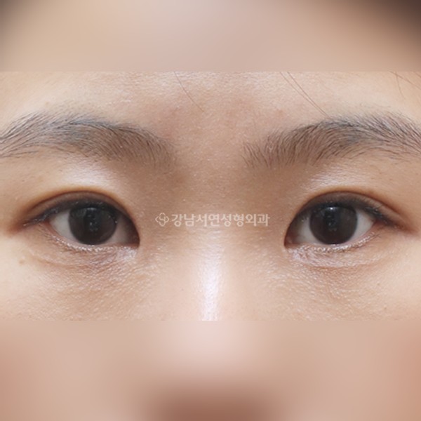 절개눈매교정+앞트임 AFTER