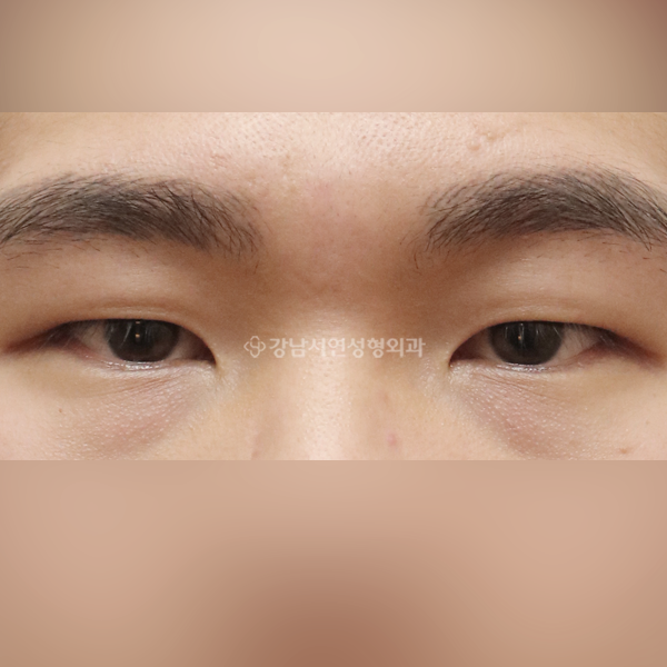 절개눈매교정+앞트임 BEFORE
