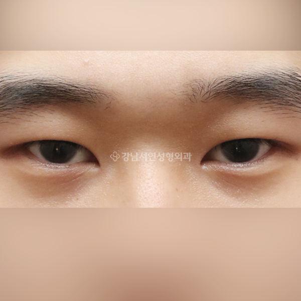 절개눈매교정 AFTER