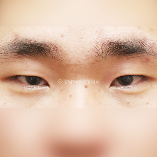 절개눈매교정+앞트임+뒷트임+밑트임 BEFORE