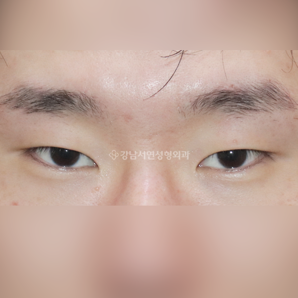 절개눈매교정+앞트임+뒷트임+밑트임 BEFORE
