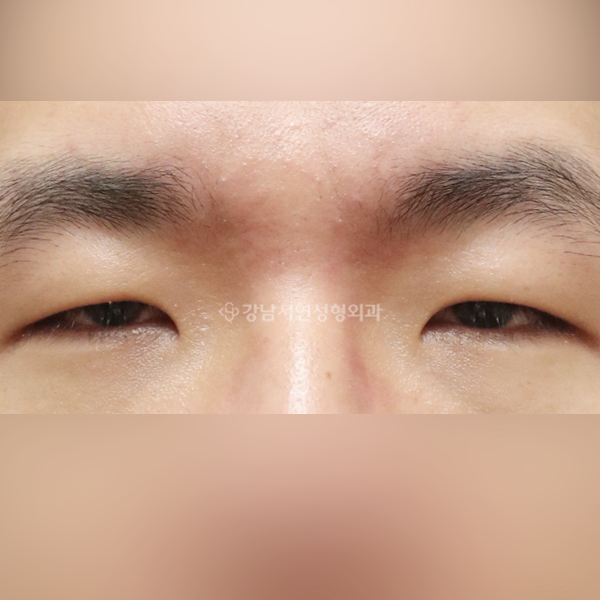 절개눈매교정+앞트임 BEFORE