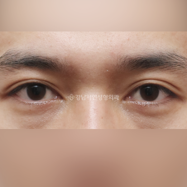 절개눈매교정 BEFORE