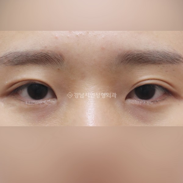 절개눈매교정+앞트임 BEFORE