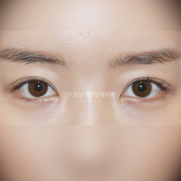 절개눈매교정 AFTER