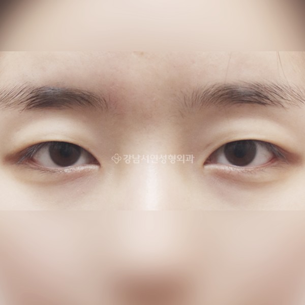 절개눈매교정 BEFORE