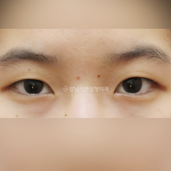절개눈매교정+앞트임 BEFORE